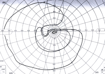 goldmann visual field with a quarter field missing from glaucoma