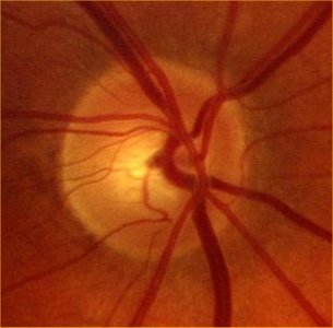 a slightly cupped disc in chronic glaucoma 0.7c/d