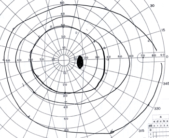normal goldmann visual field