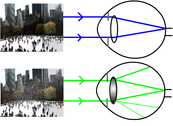 large diagram of cataracts