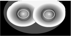 glare from car headlights in cataracts