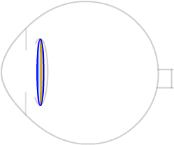 lens implant after cataract surgery