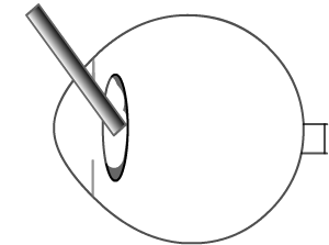 cataract surgery