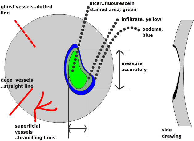 draw the conral ulcer accurately