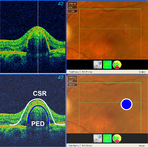 central serous retinopathy with a pigment epithelial detachment