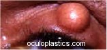 chalazion (present a long time)