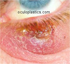 a healing chalazion