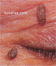 eyelid papilloma,eyeatlas.com
