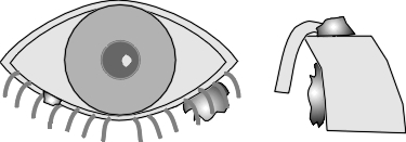 eyelid papilloma