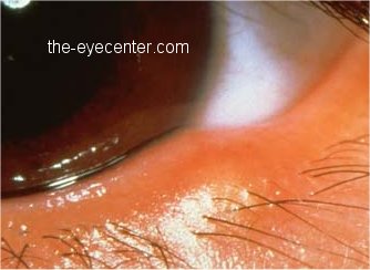 stye,the eyecentre.com