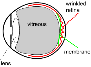 epiretinal membrane drawing