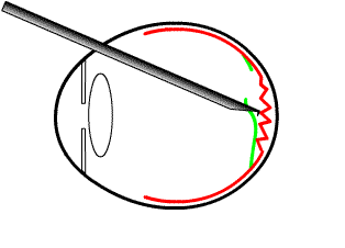 removing an epiretinal membrane