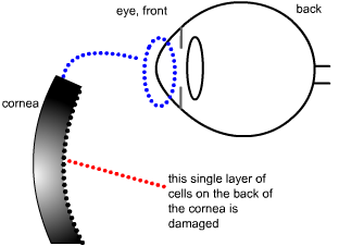 Fuch's corneal dystrophy....endothelial cell loss
