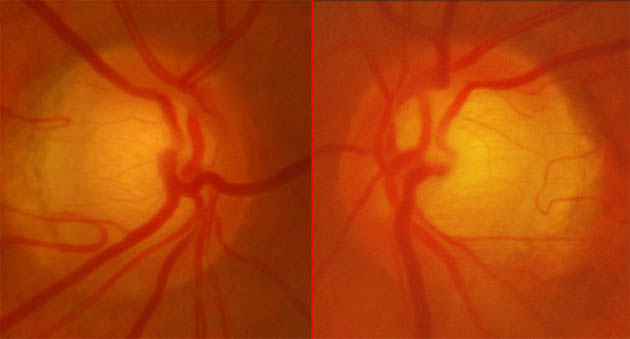 2011, full visual field, no tgreatment. Over the next 10 months a left field defect developed
