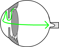 if the trabecular meshwork blocks, fluid cannot drain out of the eye, the pressure goes up, and the pressure is transmitted to the optic nerve