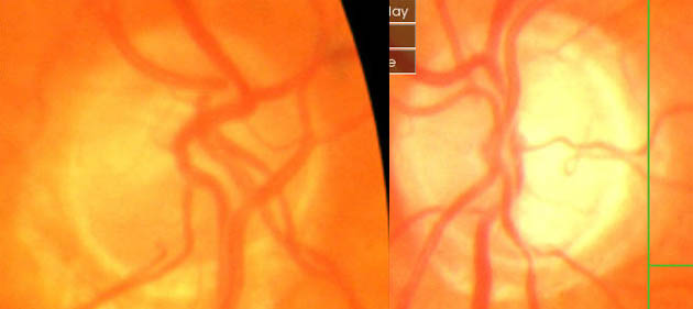 cupped  disc, progressive glaucoma left eye 9despite normal pressure)