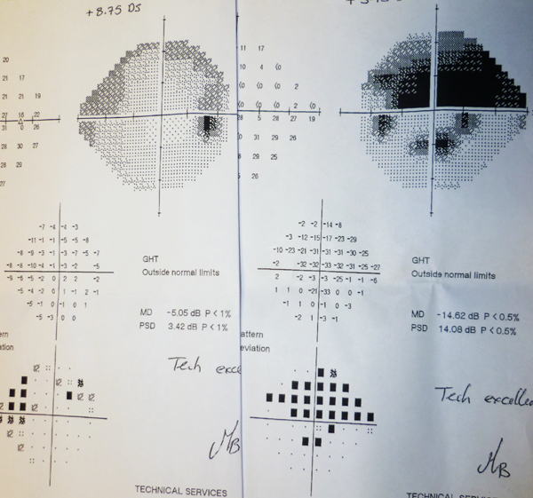 left visual field has progressed over 8 years