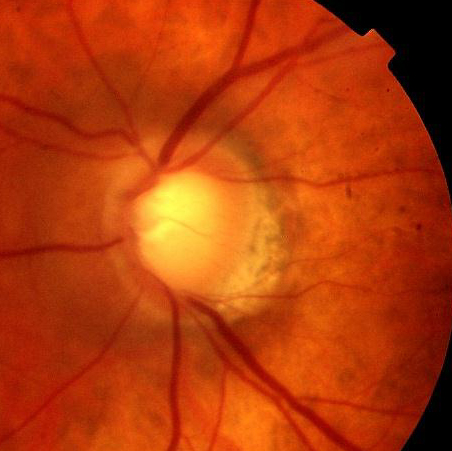 a cupped disc in glaucoma 0.9