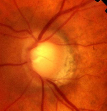  a cupped optic disc in glaucoma (0.9)