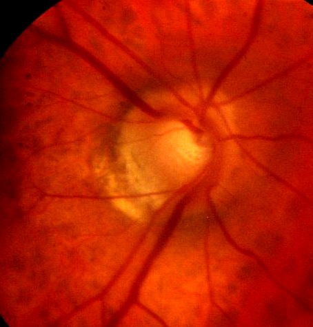 a cupped disc in glaucoma 0.7