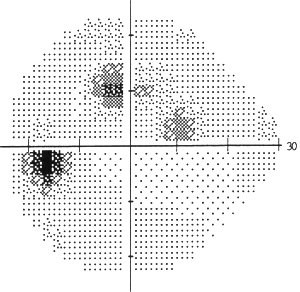 a arcuate scotma, early field defect, in glaucoma