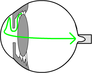 a blocked drain causes the eye pressure to rise and damage the optic nerve