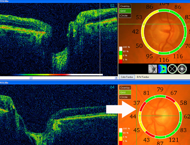 an OCT scan of optic discs: a borderline result