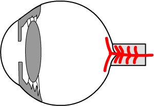low tension glaucoma may be cuased by poor blood flow to the optic nerve