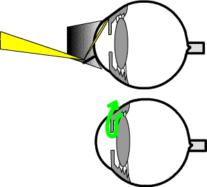 slt laser is a new  treatment for open angle glaucoma