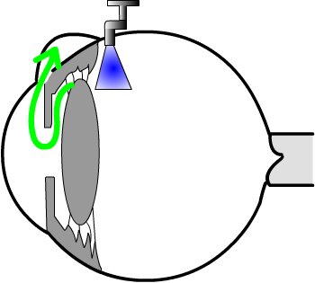 trabeculectomy...surgery lowers eye pressure