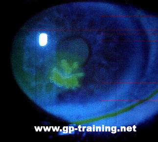 a dendritic corneal ulcer