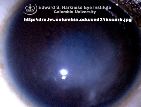 a corneal scar..similar to an old herpes simplex scar