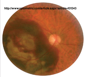 www.optometirc.com macular haemorrhage