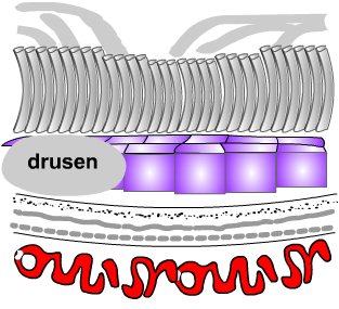retinal drusen