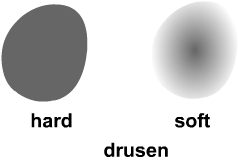 hard and soft retinal drusen