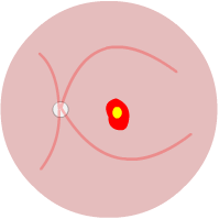 classic subfoveal CNV