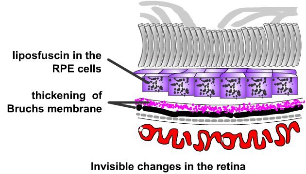 thickening of bruchs membrane with age in macular degeneration, diagram