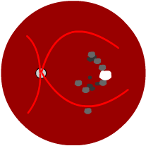 mixed macular degeneration, diagram