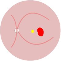 classic extra-foveal CNV