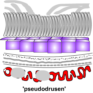 pseododrusen = reticular drusen: predispose to wet ARMD