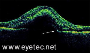 OCT showing fluid due to CNV