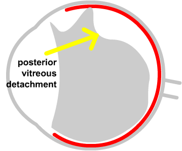 Posterior vitreous detachment