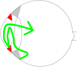 diagram of rubeotic glaucoma
