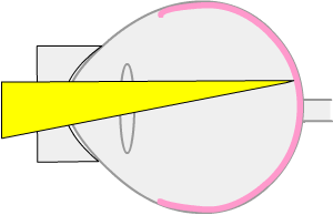 side view of eye showing retinal laser