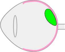 retinal leakage after a retinal vein occlusion