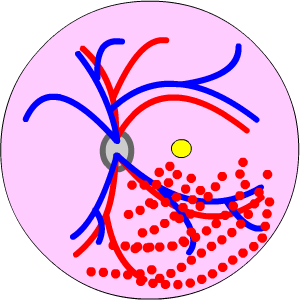 medium retinal vein occlusion, click to enlarge