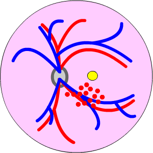 small branch retinal vein occlusion, click to enlarge