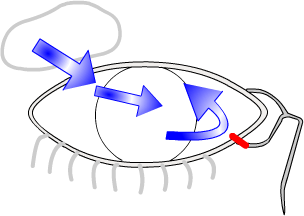 canalicular plug for dry eyes