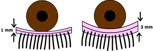 thickened in chronic blepharitis