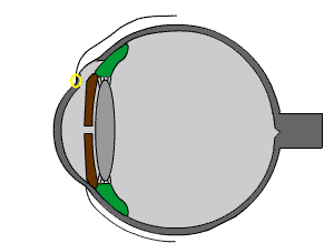 previous trabeculectomy: the valve may block with cataract surgery